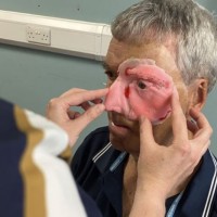 3D-друк допомагає відновити обличчя 75-річного велосипедиста в новому закладі NHS Bristol